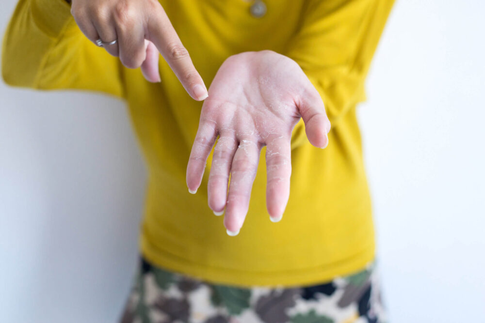 手のひらや指の皮がむける時のスピリチュアルな3つの意味とは？